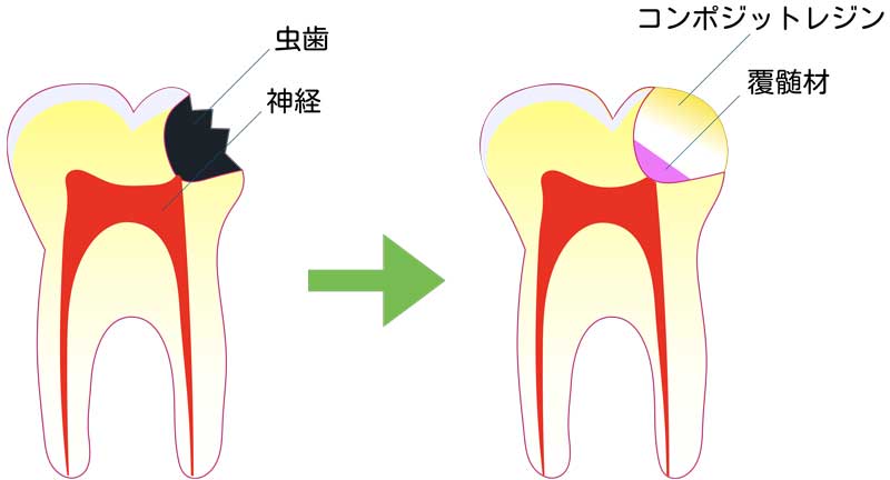 覆髄治療