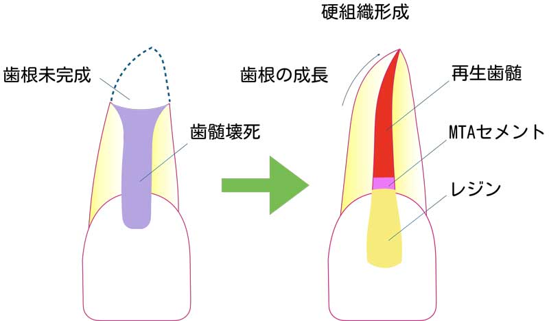 再生歯内療法