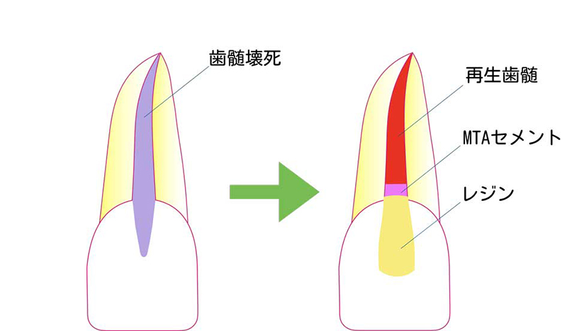 歯髄再生療法