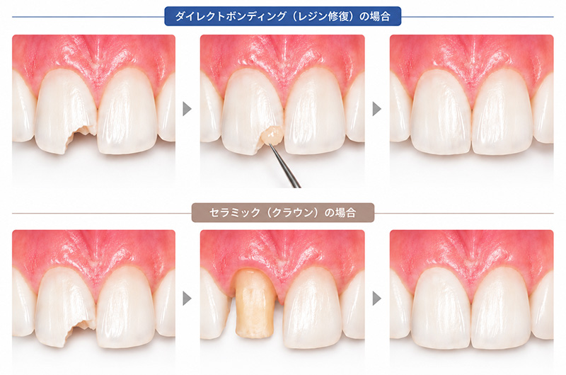 ダイレクトボンディングとセラミックの比較イメージ図